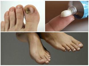 fungus toenails ointment
