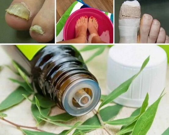 Tea tree for nails fungus