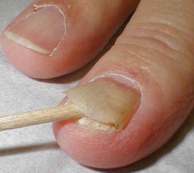 peeling of the nail with toenail fungus