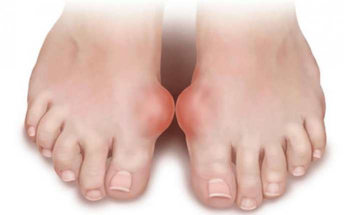 deformity of the foot as the cause of the appearance of fungus on the legs
