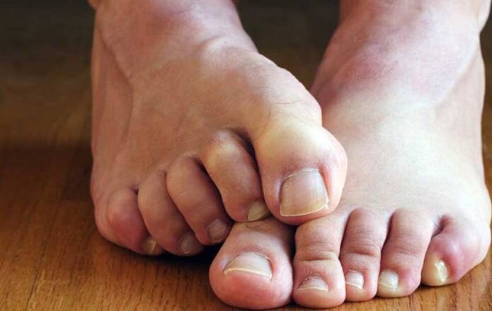 symptoms of squamous fungus on the feet