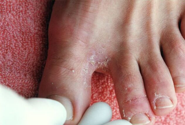 symptoms of fungus between the toes