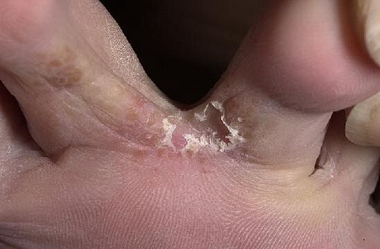 toes affected by fungus
