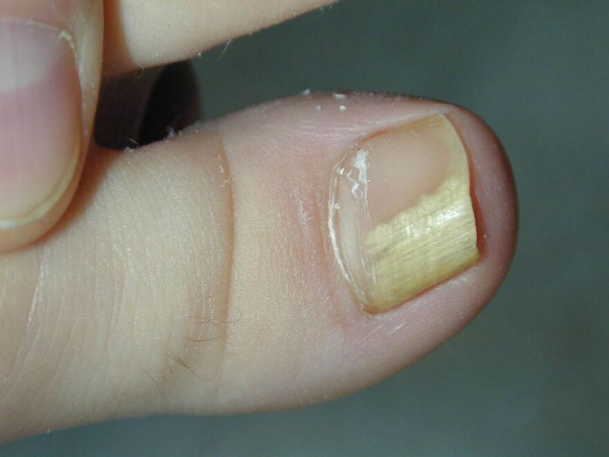 Fungus symptom - discoloration of the nail