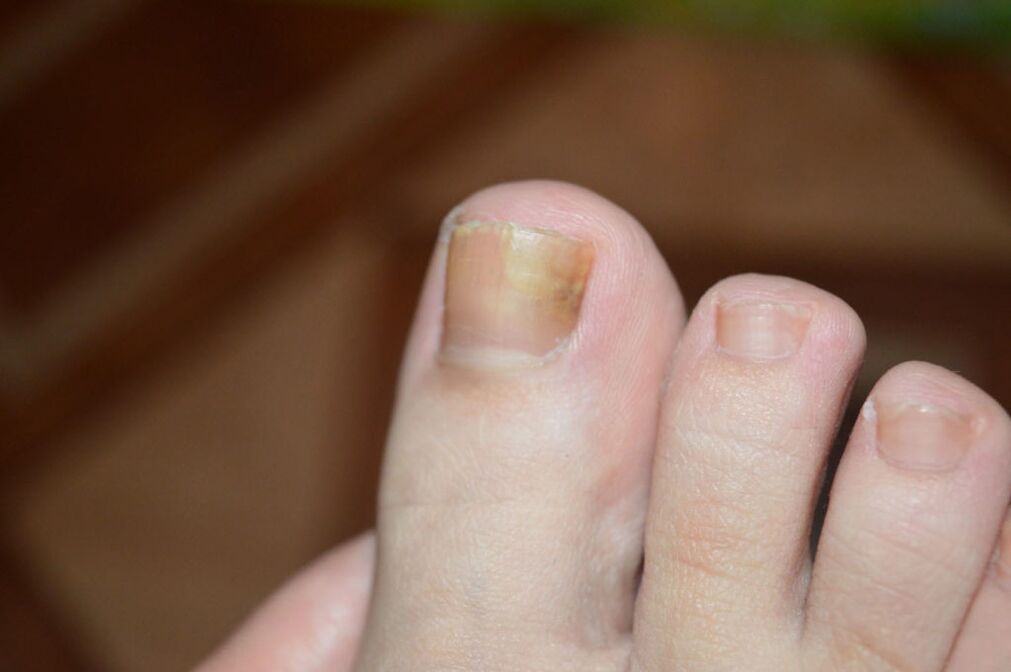 The initial stage of toenail fungus