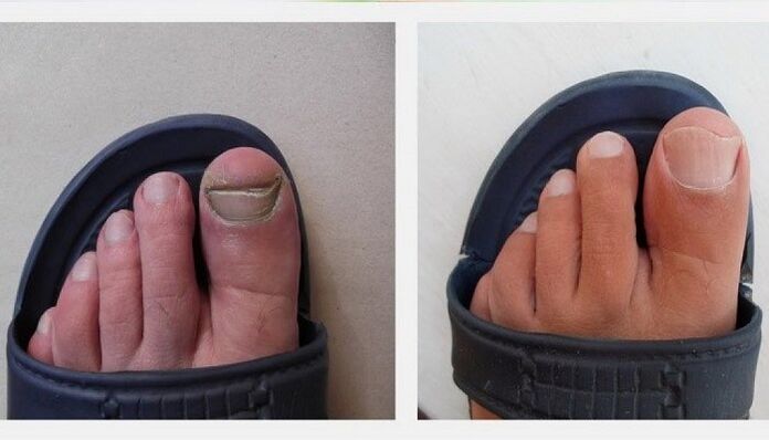 toenails before and after treating the fungus with apple cider vinegar