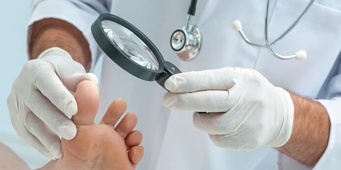 The doctor examined the foot infected with a fungus