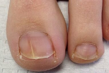 Finger nail fungus