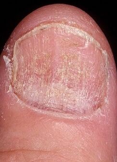 Mycosis of the nail