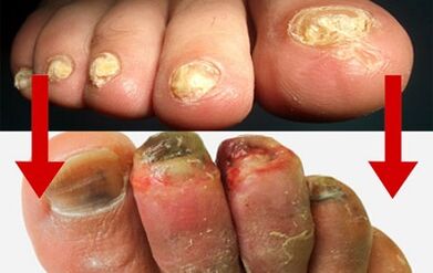 manifestations of the fungus on the fingers