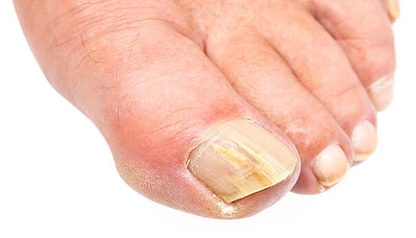 fungus on toenails