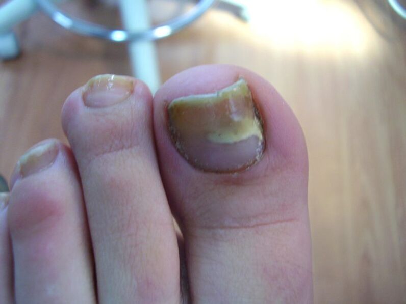 How to treat yellow nails due to fungus with drops