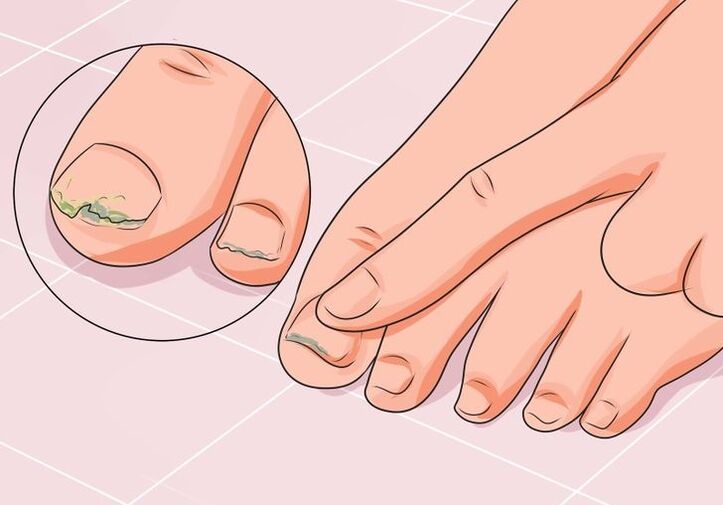how to treat toenail fungus with drops