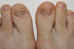 Symptoms of foot fungus