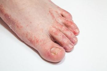 foot fungus and nails